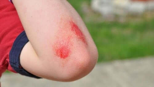 Skrubbsår på en albue.