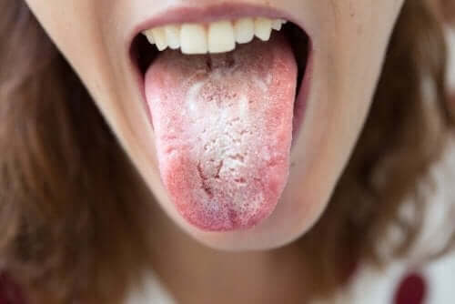 Syv naturlige midler mot en hvit tunge