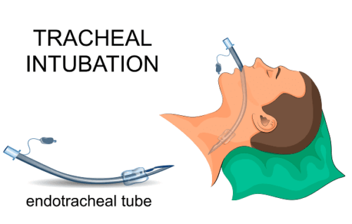Endotrakeal tube.
