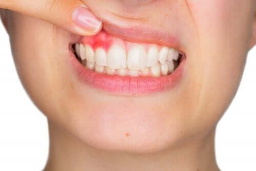 Å bruke munnskyllevann kan hjelpe mot tannkjøttbetennelse. 