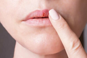 Herpes simplex-virus og deres egenskaper