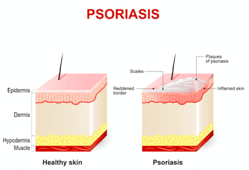 En illustrasjon av psoriasis.