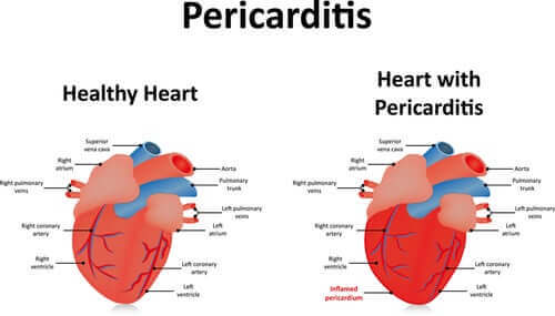 En sammenligning av et sunt hjerte vs et sykt hjerte.