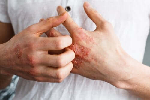 Hva er hudlidelsen atopisk dermatitt?