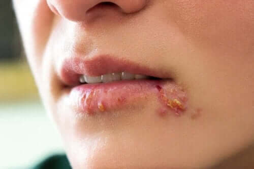 Kvinne med utbrudd av herpes simplex-virus rundt munnen.