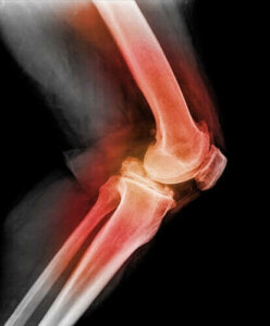 Lær alt om dislokasjon av kneskålen