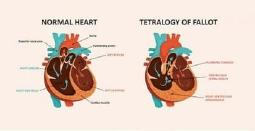 Diagram hjertesyndrom.