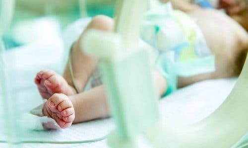 Gastroschise hos nyfødte babyer.