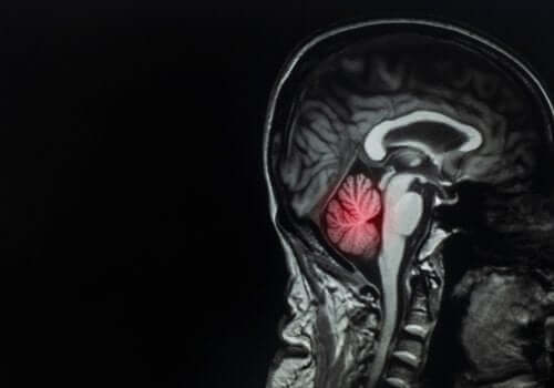 Kreftspredning til hjernen: Beskrivelse og behandling