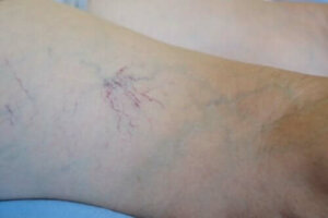 Preparatet Venoruton – egenskaper og bruksområder