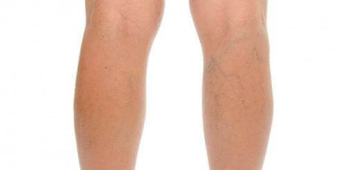 Åreknuter i et bein