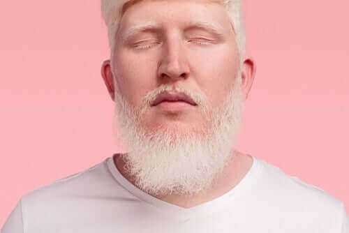 En mann med albinisme.