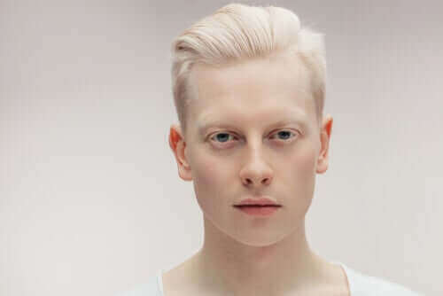 Alt du behøver å vite om albinisme