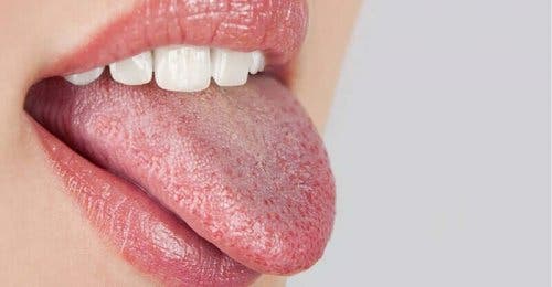 Brennende munn viser seg som en brennende følelse på hele tungen og i munnen. 