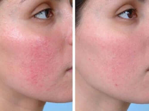 Et før og etter bilde av en kvinne som har blitt behandlet for rosacea