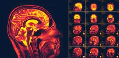 Hva er nevroplastisitet i hjernen?