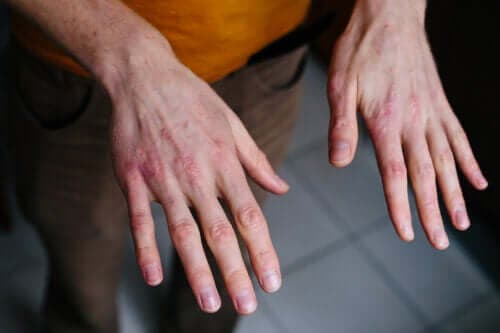 Tørre og sprukne hender: Beskyttelse fra kulden