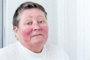 Årsaker til og symptomer på rosacea