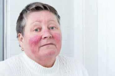 Årsaker til og symptomer på rosacea