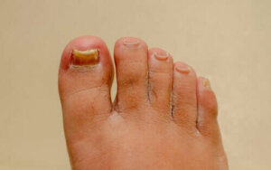 Fungerer preparater mot onykomykose på hendene og føttene?