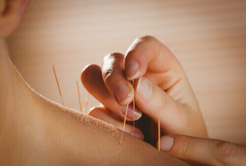 akupunktur for å lindre ryggsmerter