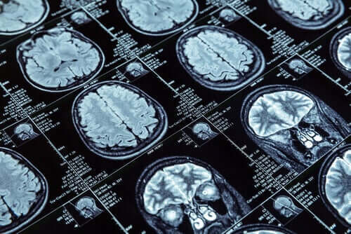 MR-bilder av en hjerne