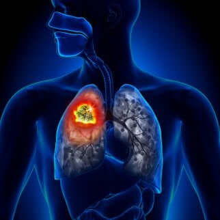 Forskjellige typer lungekreft