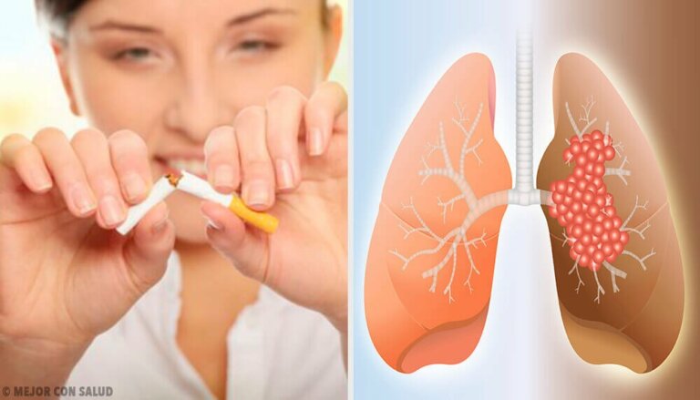 Årsaker og diagnose av lungekreft