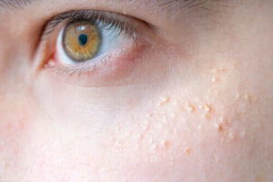 Naturlige behandlinger mot keratosis pilaris