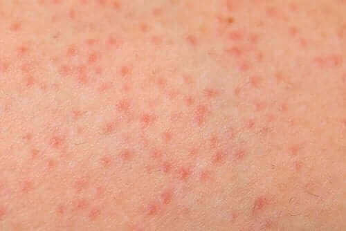 Keratosis pilaris