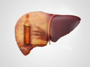 Alkoholisk hepatitt: Symptomer, årsaker og behandlinger