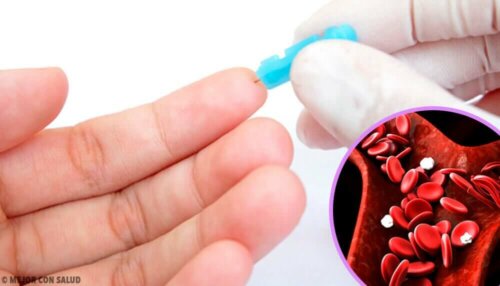 Lave hemoglobinnivåer.