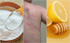 Lindre loppebitt med 5 smarte hjemmeremedier