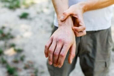 En hånd med granuloma annulare