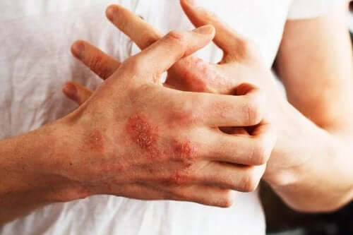En mann med psoriasis på hendene.