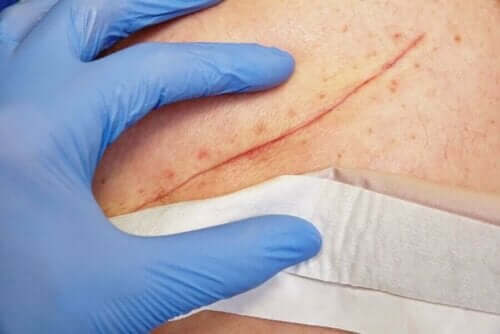 Klorheksidin kan brukes til å rense sår.