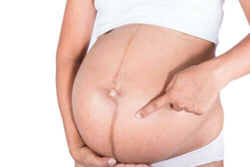 Gravid kvinne som peker på strekkmerker.