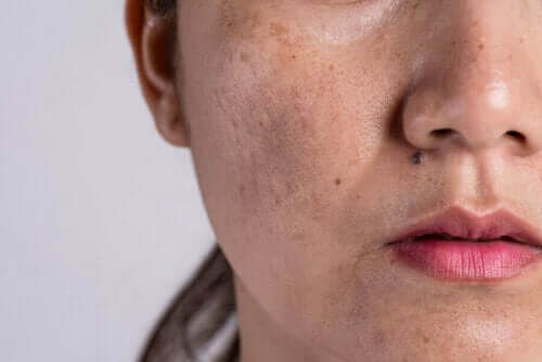 Kvinne med melasma i ansiktet, hudforandringer på grunn av graviditet.