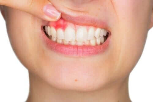 Tannkjøttbetennelse i tannkjøttet, hyaluronsyre kan bekjempe visse forhold.