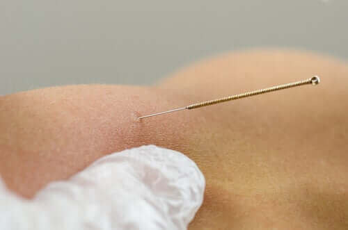 Dry needling.