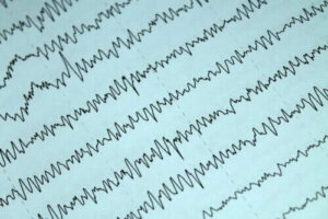 Slik kan du håndtere epilepsi og amming