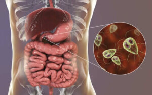 Symptomer og behandling av giardiasis