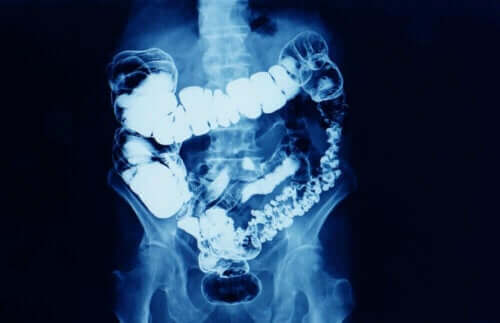 Irritabel tarmsyndrom - røntgen