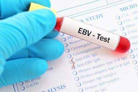 Epstein-Barr virus er hovedagenten bak mononukleose. I en analyse er det kjent ved initialene EBV. 