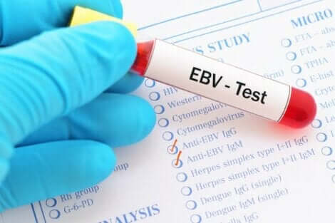 Epstein-Barr virus er hovedagenten bak mononukleose. I en analyse er det kjent ved initialene EBV.