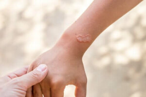 Hva er ektoparasitter? Alt om midd og lopper