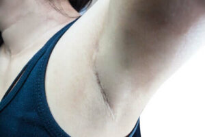 Hva er en vaktpostlymfeknute?