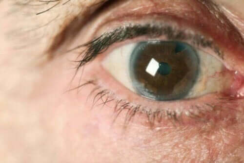 Et nærbilde av et øye med glaukom