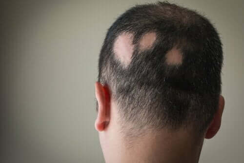 En mann med alopecia aratea