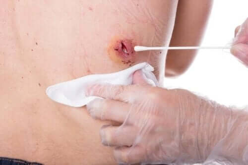 Sykepleier pleier en cyste